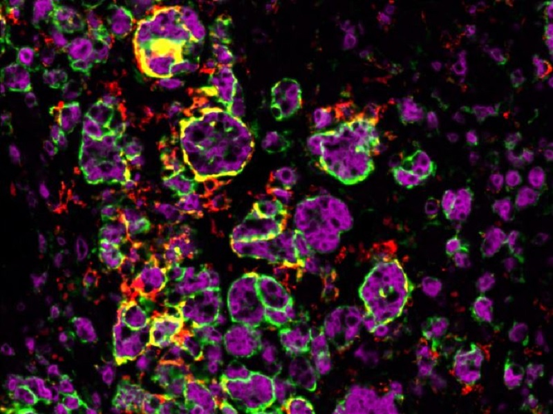 Macrophages attaquant la tumeur surr��nalienne d��une souris m?le. ? Julie Olabe CNRS/GReD